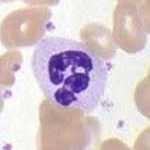 If you want to classify white blood cells, you will encounter skew. In a normal sample of blood you will find 62% neutrophils, but only 0.4% basophils. Basophils will be heavily underrepresented in your training data. Images public domain via Wikimedia Commons.